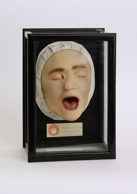 Wax moulage of a face with syphilis scars, Max Broyer, ca. 1925